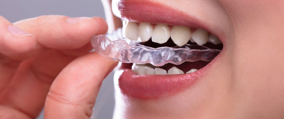 Solution orthodontique pour les adultes